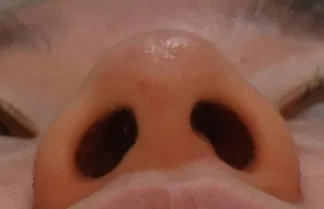 alar-reduction-korea-nostril-narrowing-real-results related image
