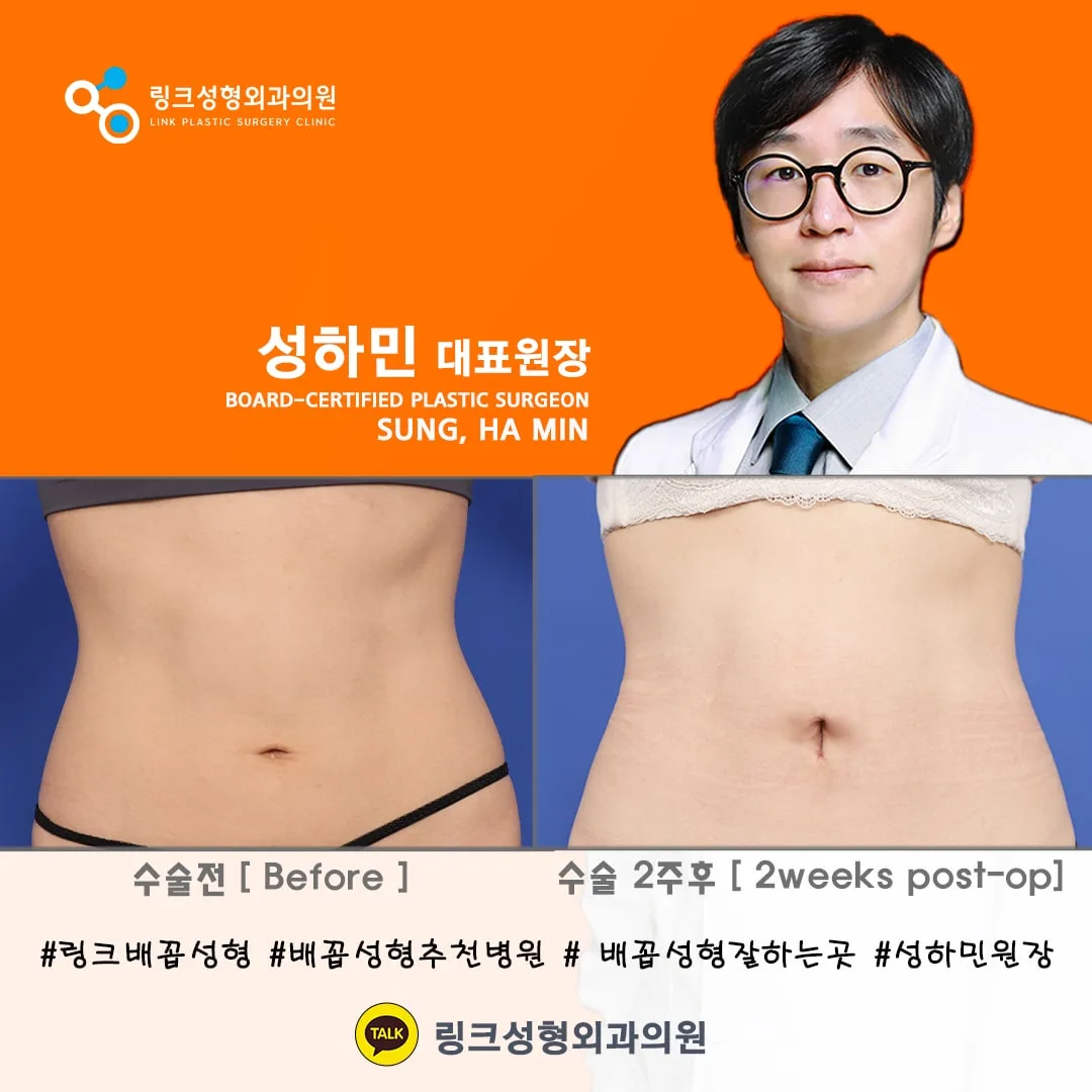 korean-belly-button-surgery-tummy-tuck related image