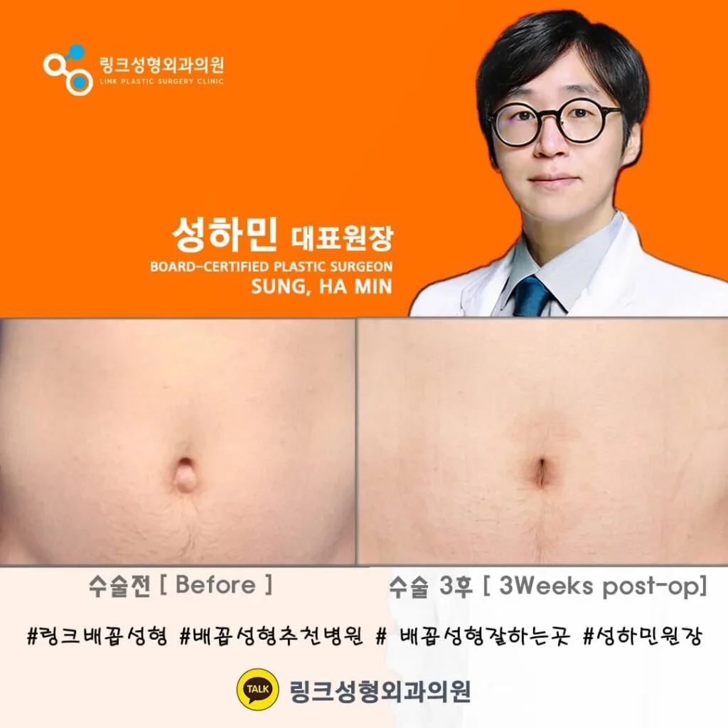 korean-belly-button-surgery-tummy-tuck related image