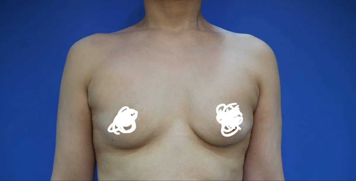 breast-augmentation-korea-recovery-photos-real-results related image