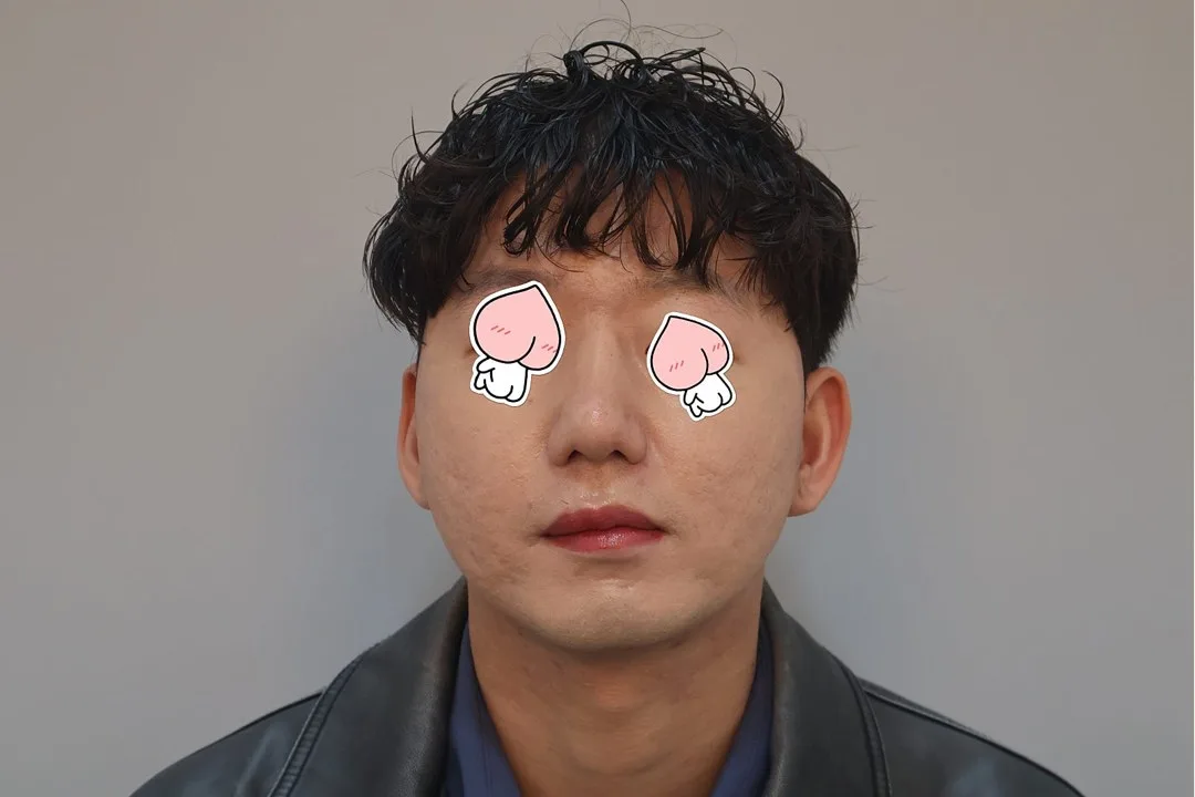 korean-rhinoplasty-1-month-recovery-foreign-patients-guide related image