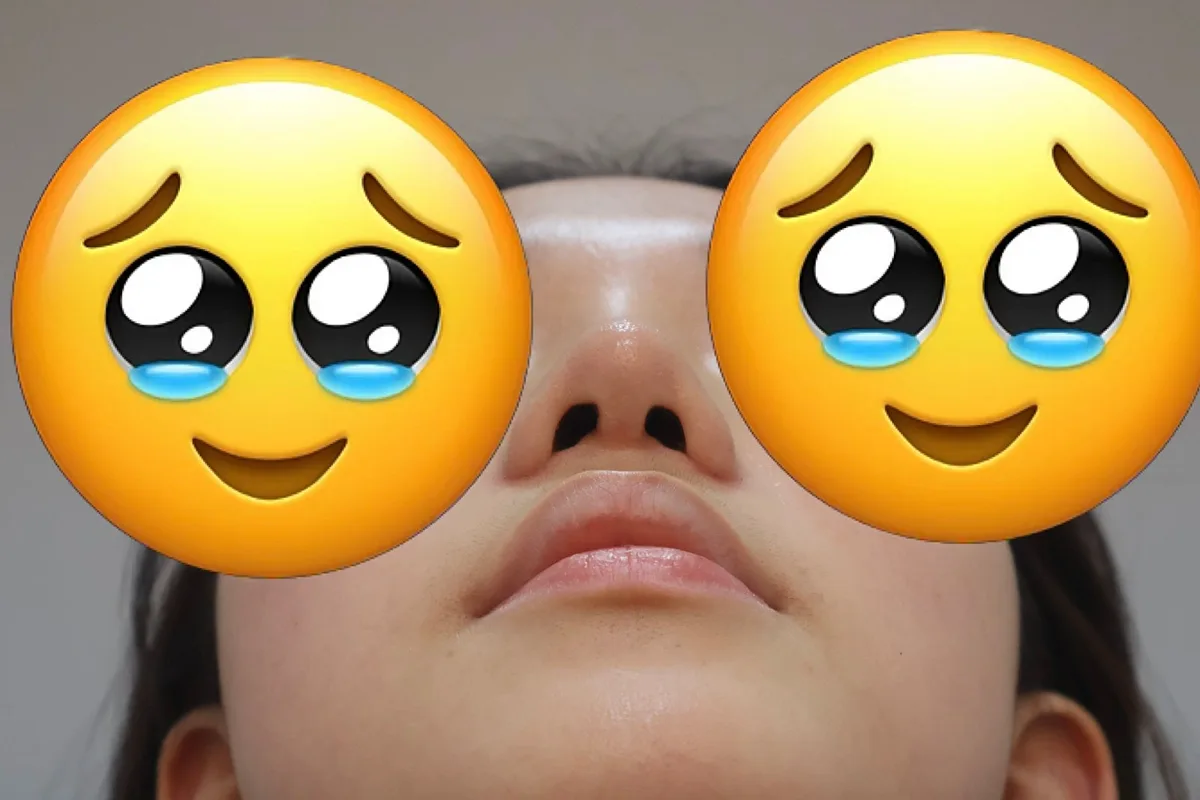 korean-rhinoplasty-results-1-month-recovery related image