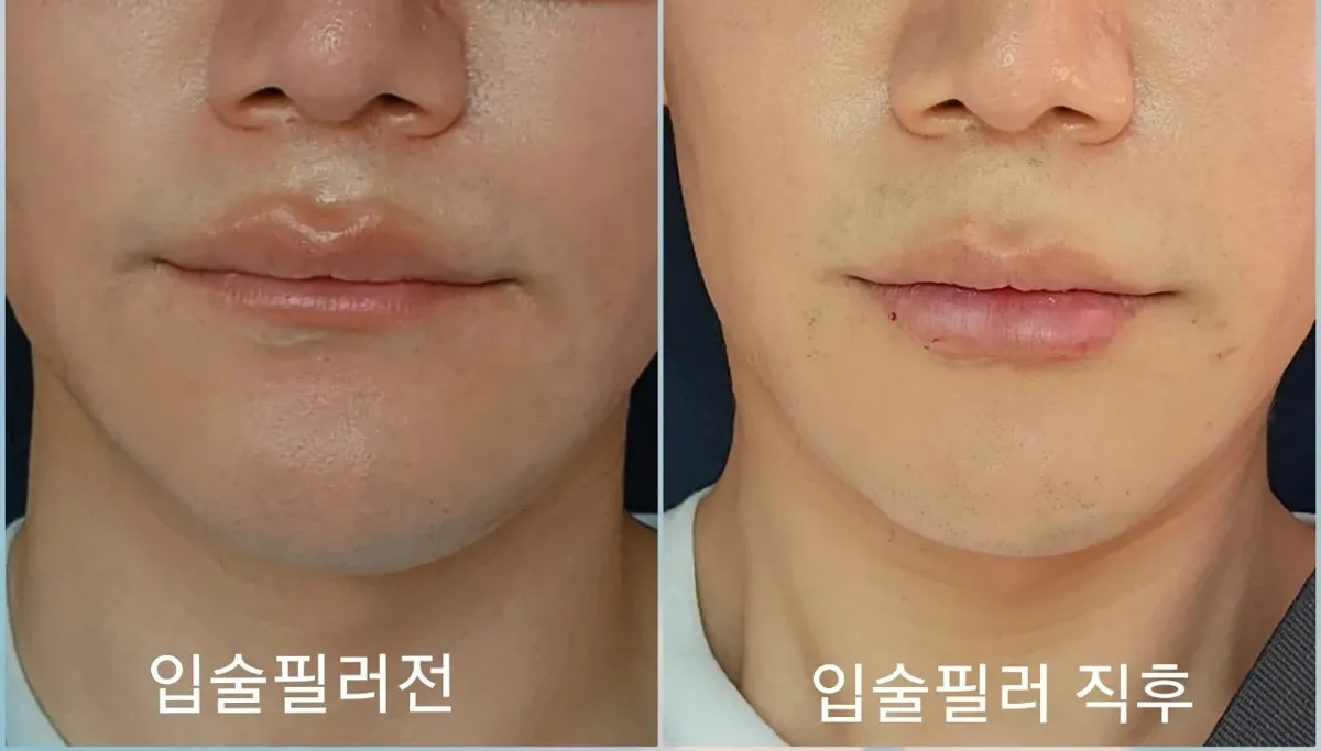lip-filler-korea-real-results-korean-technique related image