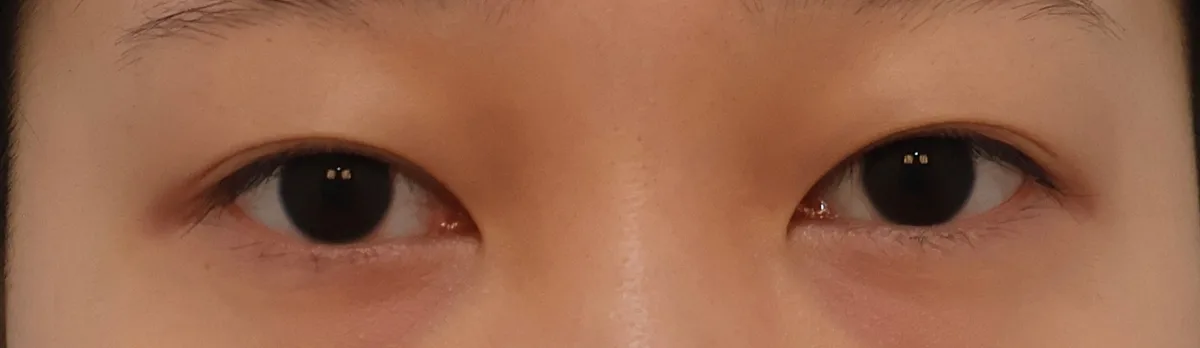 upper-eyelid-fat-removal-korea-real-results related image