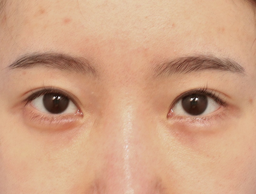 Double Eyelid Before