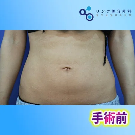 [リアル口コミ] へそ形成のビフォーアフター