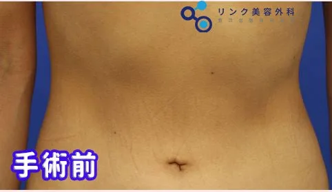 [リアル口コミ] へそ形成のレビュー