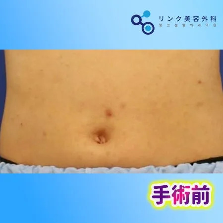 [リアル口コミ] へそ形成１ヶ月目のレビュー
