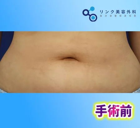 [リアル口コミ] へそ形成２週目のレビュー