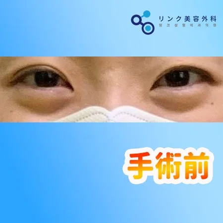 [リアル口コミ] 二重修正（他院修正）＋目つき矯正２週目のレビュー