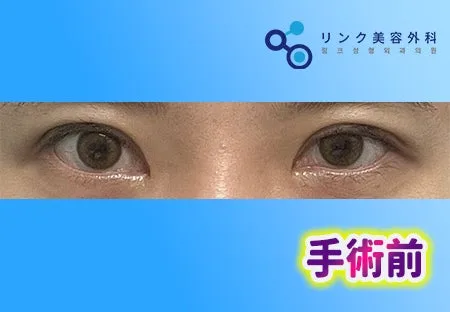 [リアル口コミ 二重修正（他院修正）２週目のレビュー