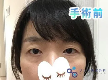 [リアル口コミ] 二重全切開＋目つき矯正＋白鳥パッケージ＋糸リフト１年目レビュー