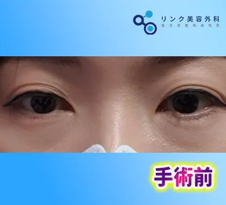 [リアル口コミ] 二重全切開＋目つき矯正＋目尻切開＋タレ目形成＋目の下脂肪再配置２ヶ月目のレビュー