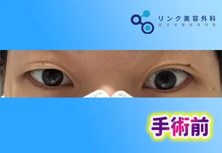 [リアル口コミ] 二重切開＋目つき矯正＋目尻切開＋タレ目形成１ヶ月レビュー