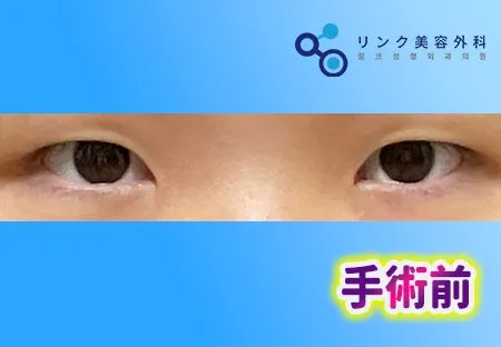 [リアル口コミ] 二重切開＋目つき矯正＋目頭切開１ヶ月目レビュー