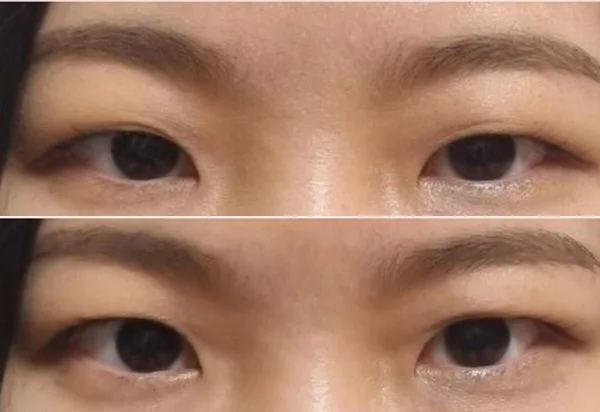 [リアル口コミ] 二重埋没（奥二重）＋上まぶたの脂肪取りの２週目のレビュー