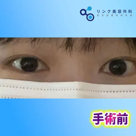 [リアル口コミ] 二重埋没＋目つき矯正