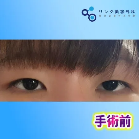 [リアル口コミ] 二重埋没＋目つき矯正3ヶ月目のレビュー