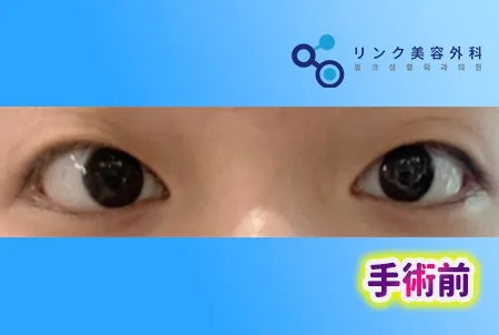 [リアル口コミ] 二重埋没＋目つき矯正＋まぶたの脂肪除去1ヶ月目のレビュー
