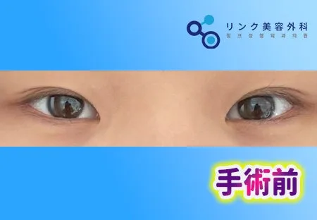 [リアル口コミ] 二重埋没＋目つき矯正＋目頭切開