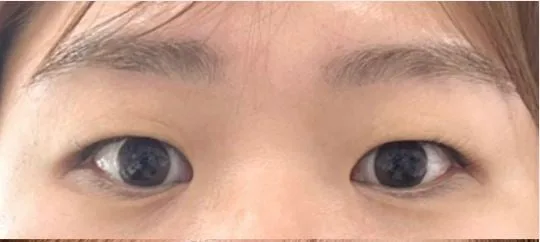 [リアル口コミ] 二重埋没＋目つき矯正＋目頭切開＋まぶたの脂肪除去1ヶ月目レビュー