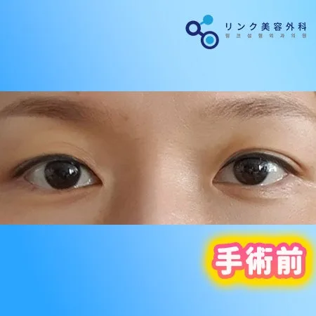 [リアル口コミ] 二重埋没＋目つき矯正２ヶ月目