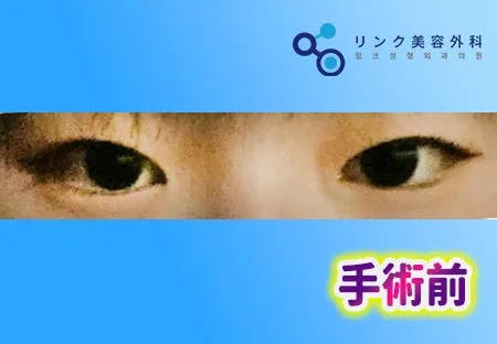 [リアル口コミ] 二重埋没＋目尻切開＋タレ目形成＋まぶたの脂肪除去）