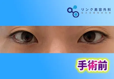 [リアル口コミ] 二重埋没＋目尻切開＋タレ目形成１ヶ月目レビュー