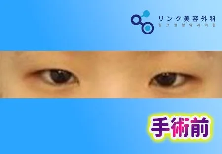 [リアル口コミ] 二重埋没＋目頭切開＋目つき矯正２ヶ月目レビュー