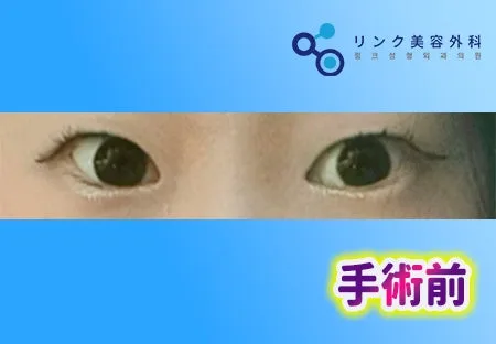 [リアル口コミ] 二重埋没＋自然癒着＋目つき矯正１ヶ月目のレビュー