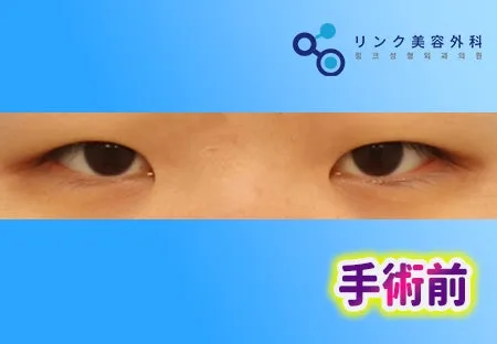 [リアル口コミ] 二重埋没２ヶ月目のレビュー