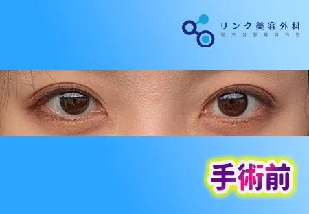[リアル口コミ] 二重整形の再手術（自然癒着）１ヶ月後のレビュー