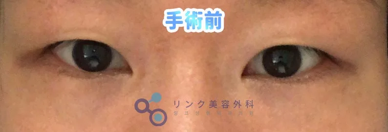 [リアル口コミ] 二重整形＋まぶたの脂肪除去＋目つき矯正のレビュー
