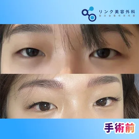 [リアル口コミ]　二重整形１ヶ月目のレビュー