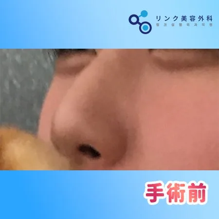 [リアル口コミ] 鼻フル整形１ヶ月目のレビュー