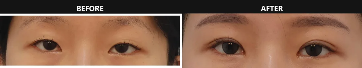 korean-double-eyelid-incision-vs-non-incision 関連画像