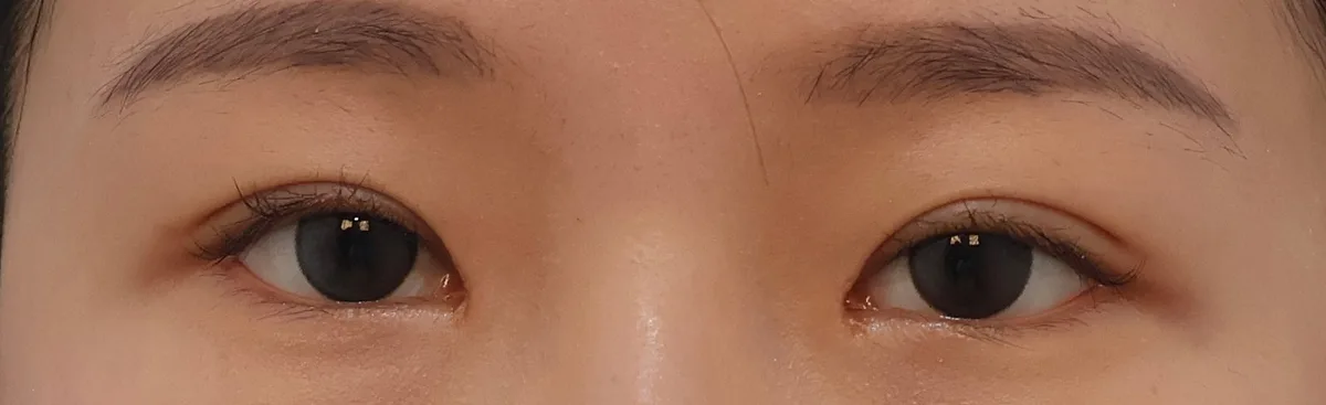 korean-double-eyelid-incision-vs-non-incision 関連画像