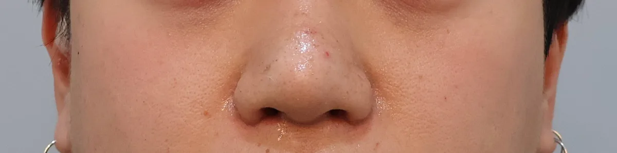 alar-reduction-korea-nostril-narrowing-real-results 関連画像