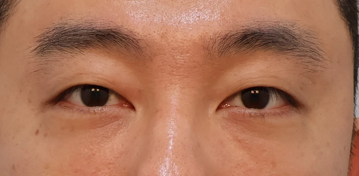 under-eye-fat-repositioning-korea-before-after-results 関連画像