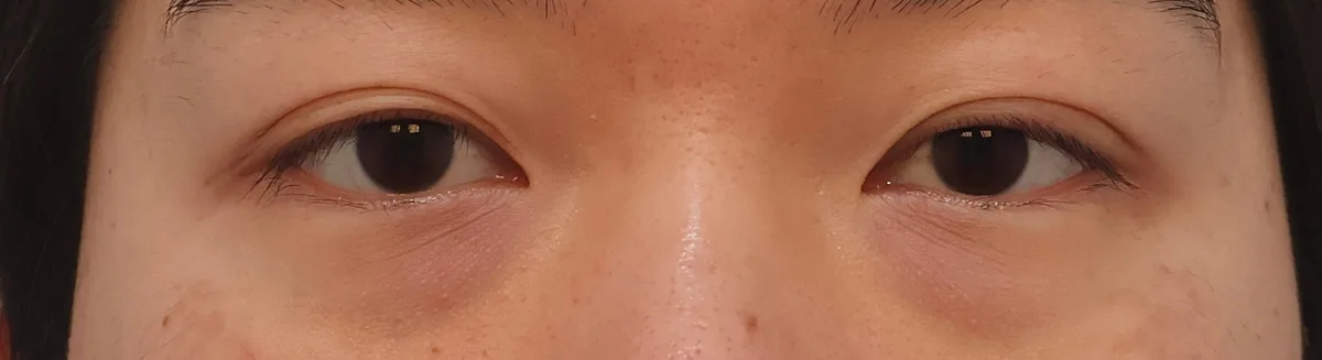 under-eye-fat-repositioning-korea-before-after-results 関連画像