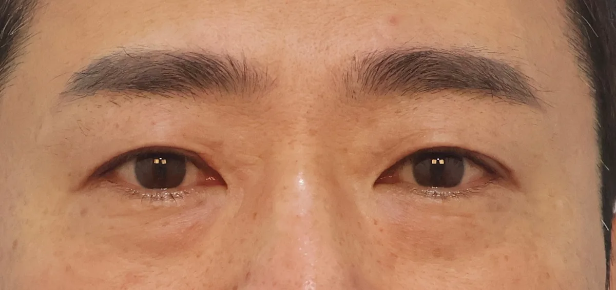 under-eye-fat-repositioning-korea-before-after-results 関連画像
