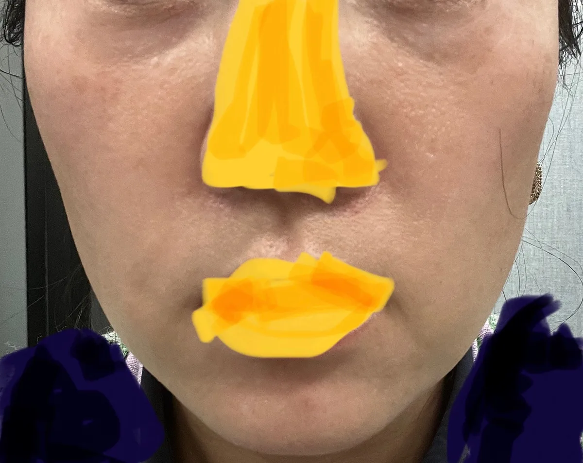 full-face-fat-grafting-korea-real-results-recovery 関連画像