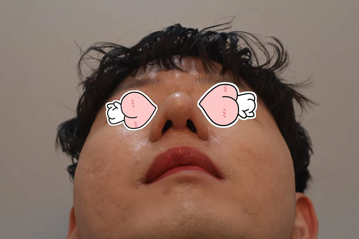 nose-tip-surgery-korea-tip-plasty-real-results 関連画像