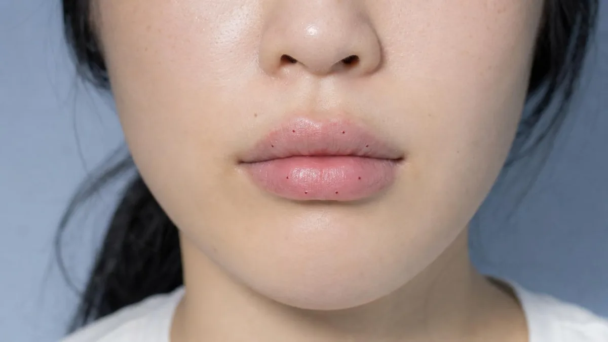 korean-lip-rejuran-pn-lip-regeneration-foreign-patients-guide 関連画像