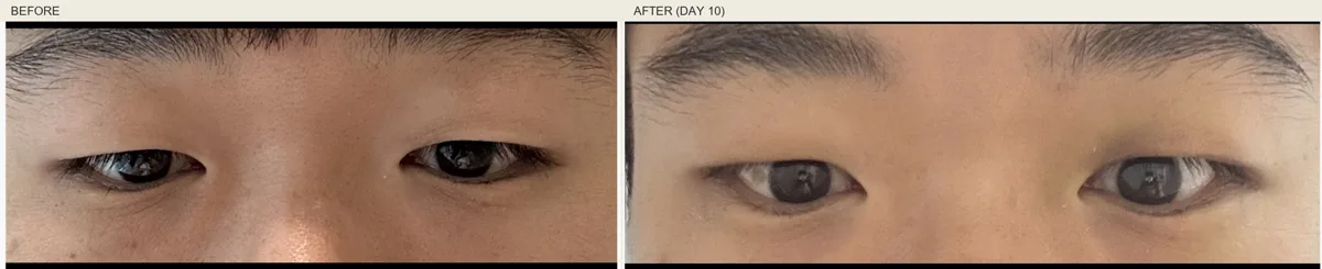 korean-upper-eyelid-fat-removal-foreign-patients-guide 関連画像