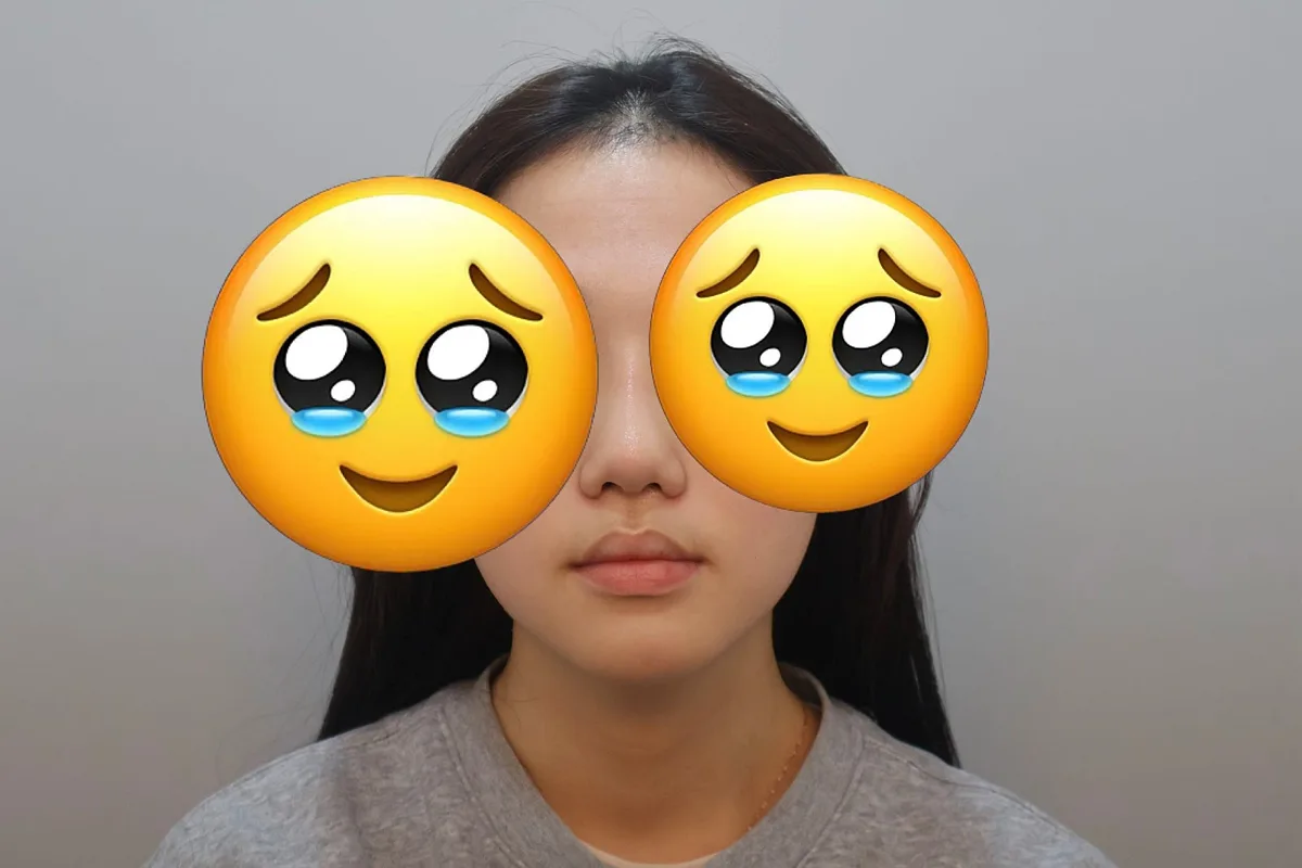 korean-rhinoplasty-results-1-month-recovery — иллюстрация