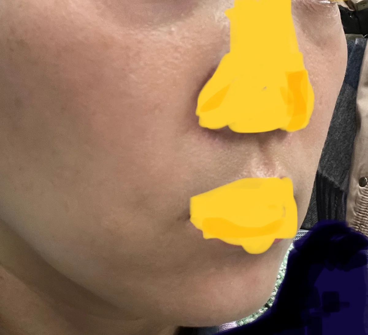 full-face-fat-grafting-korea-real-results-recovery — иллюстрация