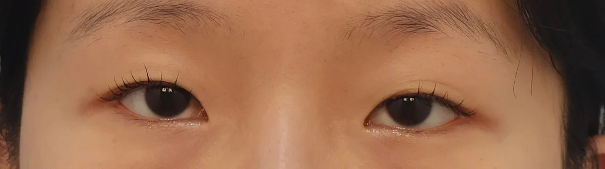 double-eyelid-surgery-korea-real-results-compared — иллюстрация