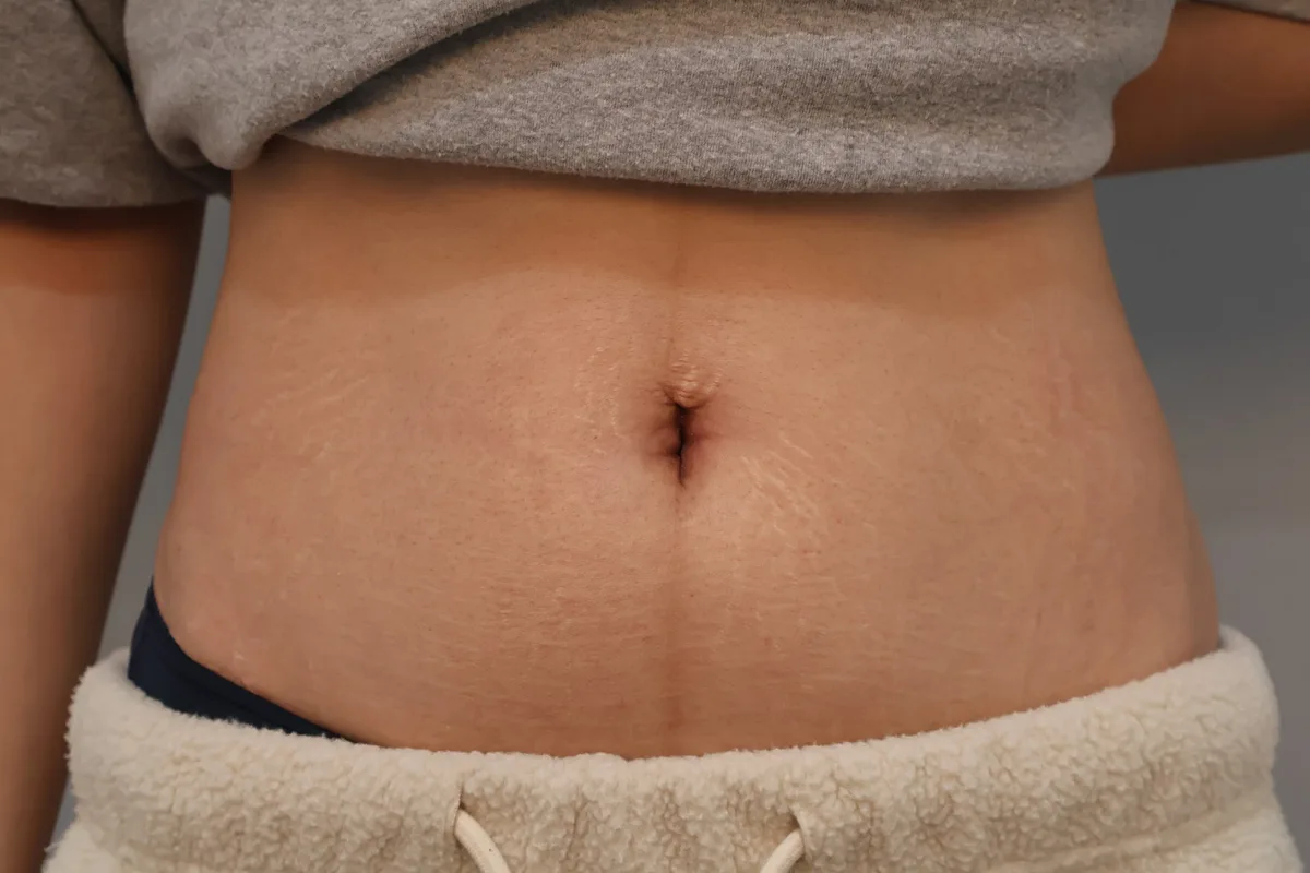 belly-button-surgery-korea-real-before-after-results — иллюстрация