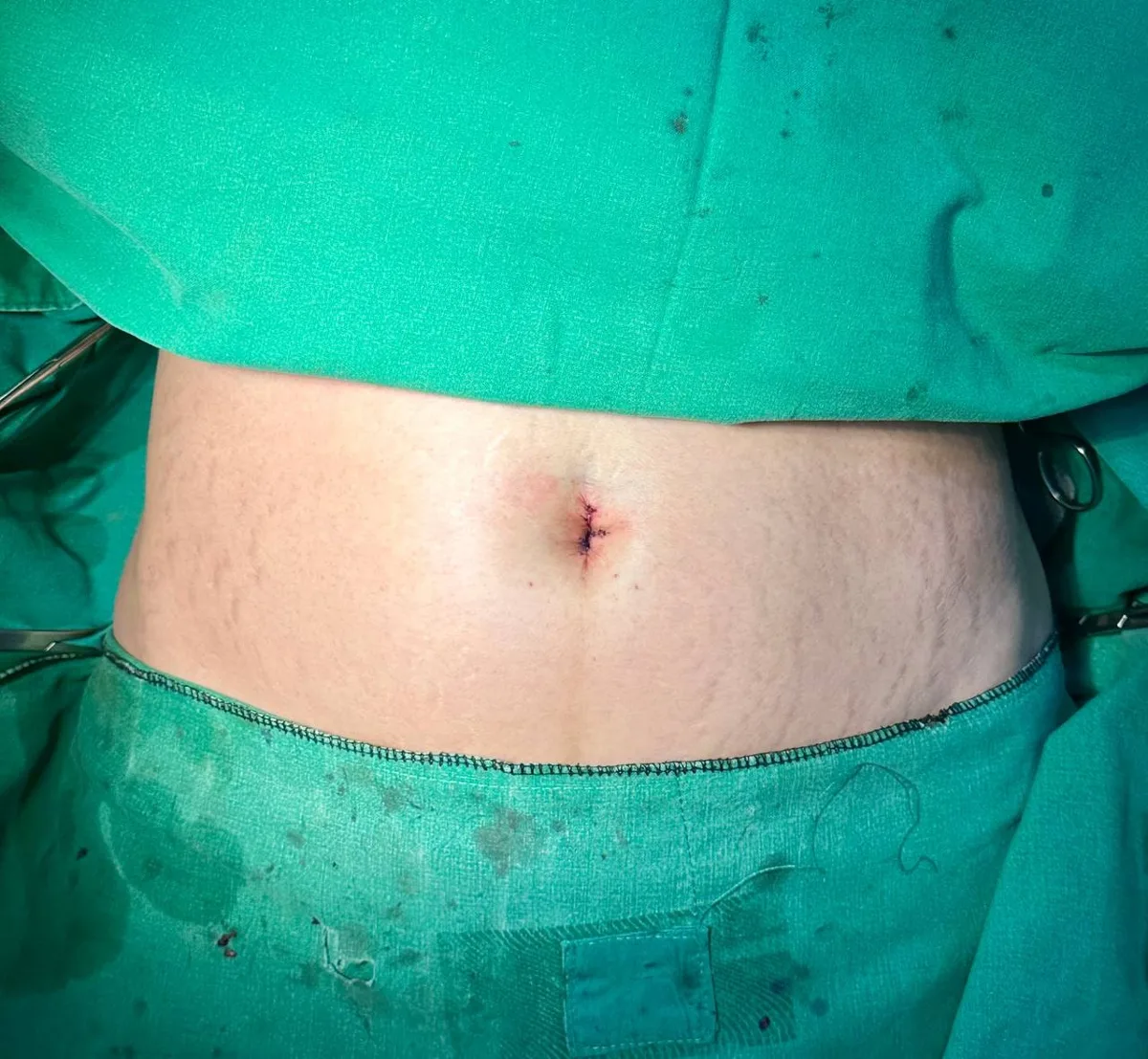 belly-button-surgery-korea-real-before-after-results — иллюстрация